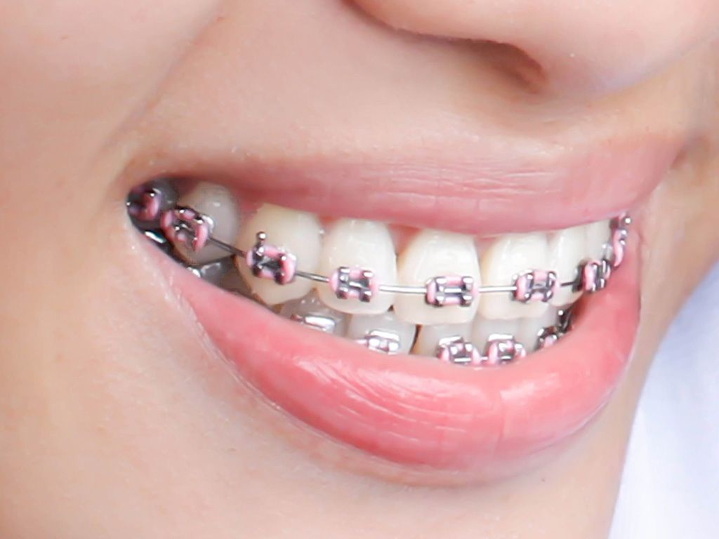 Braces Wallpapers