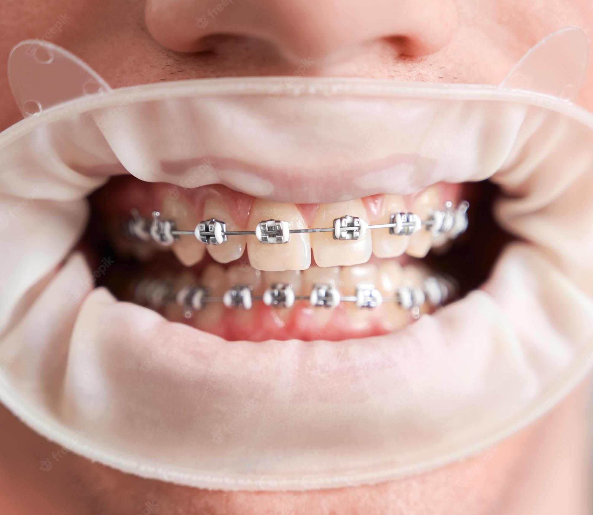 Braces Wallpapers